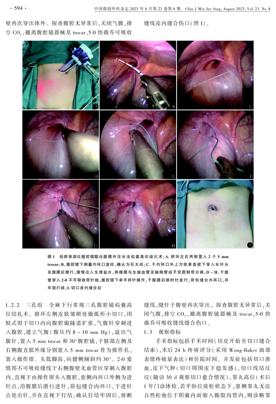 经脐单部位腹腔镜联合腹膜外注水法治疗儿童巨大腹股沟斜疝.pdf_第3页