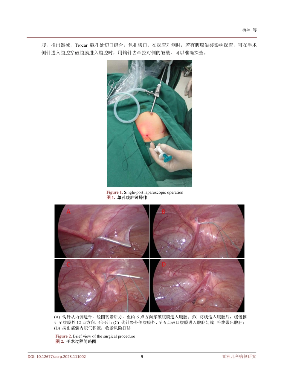 经脐单孔腹腔镜治疗女性小儿腹股沟疝84例.pdf_第3页