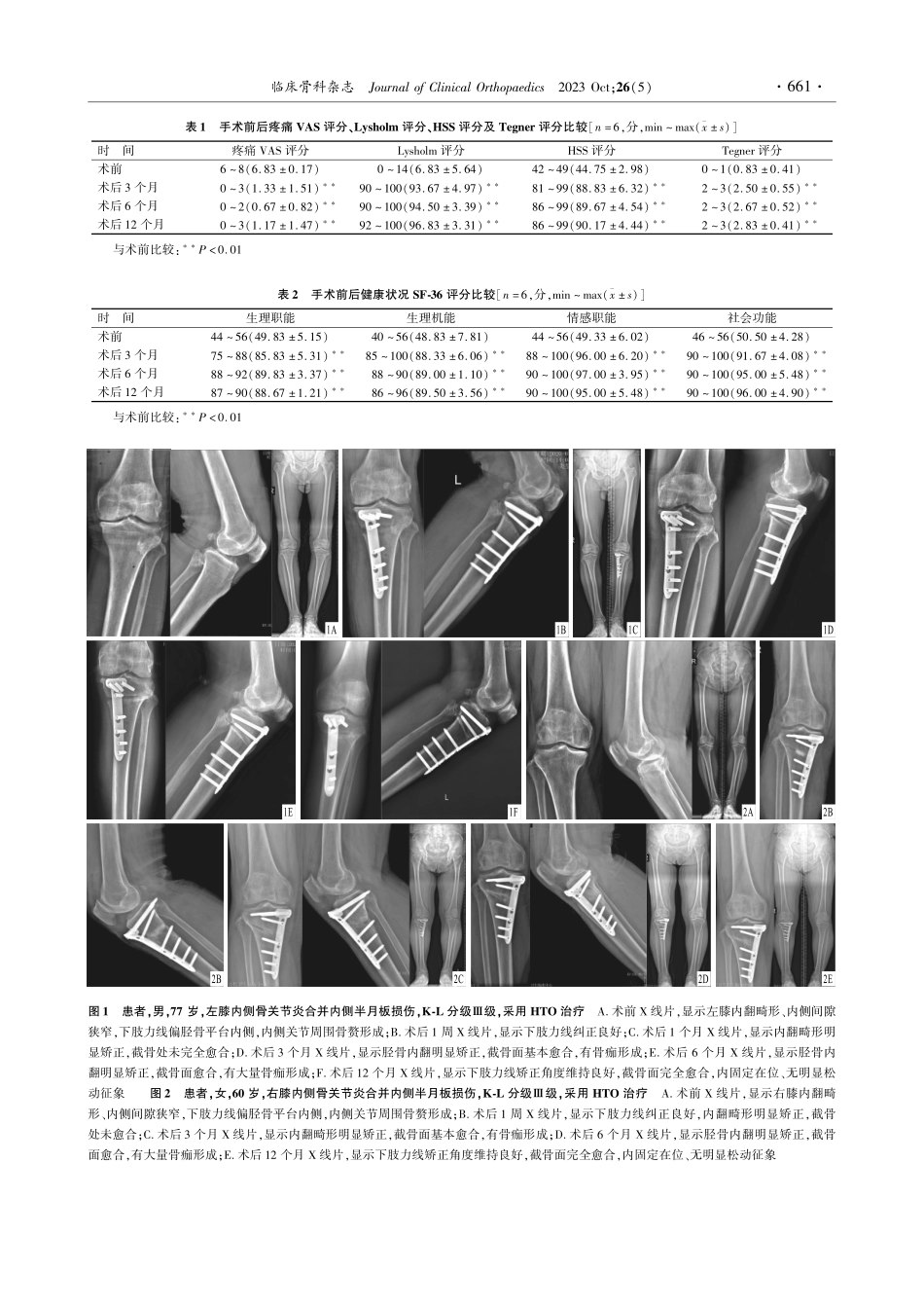 胫骨高位截骨术治疗膝骨关节炎合并半月板损伤.pdf_第3页