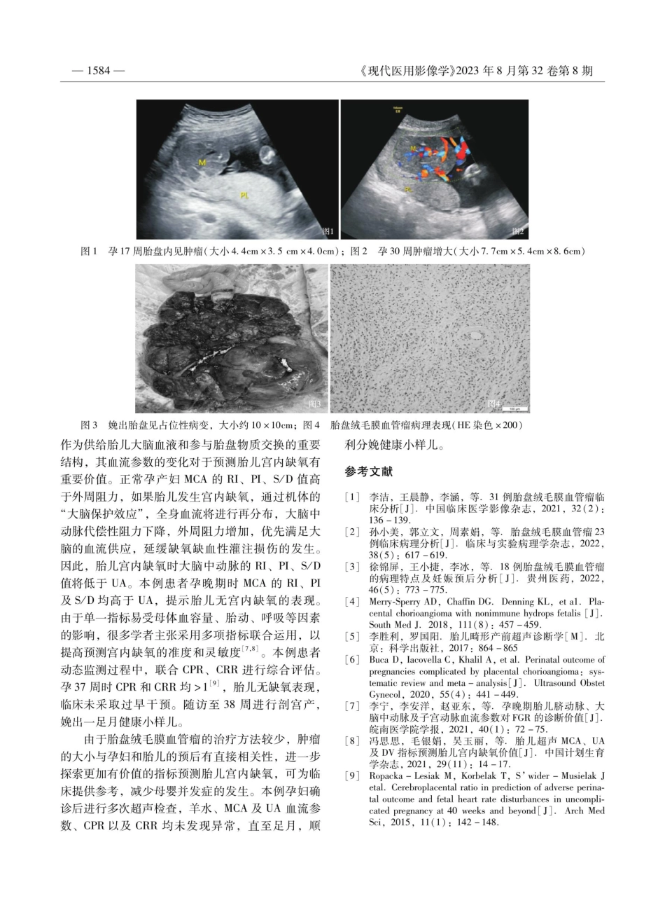 巨大胎盘绒毛膜血管瘤合并胎儿FGR超声表现1例.pdf_第2页