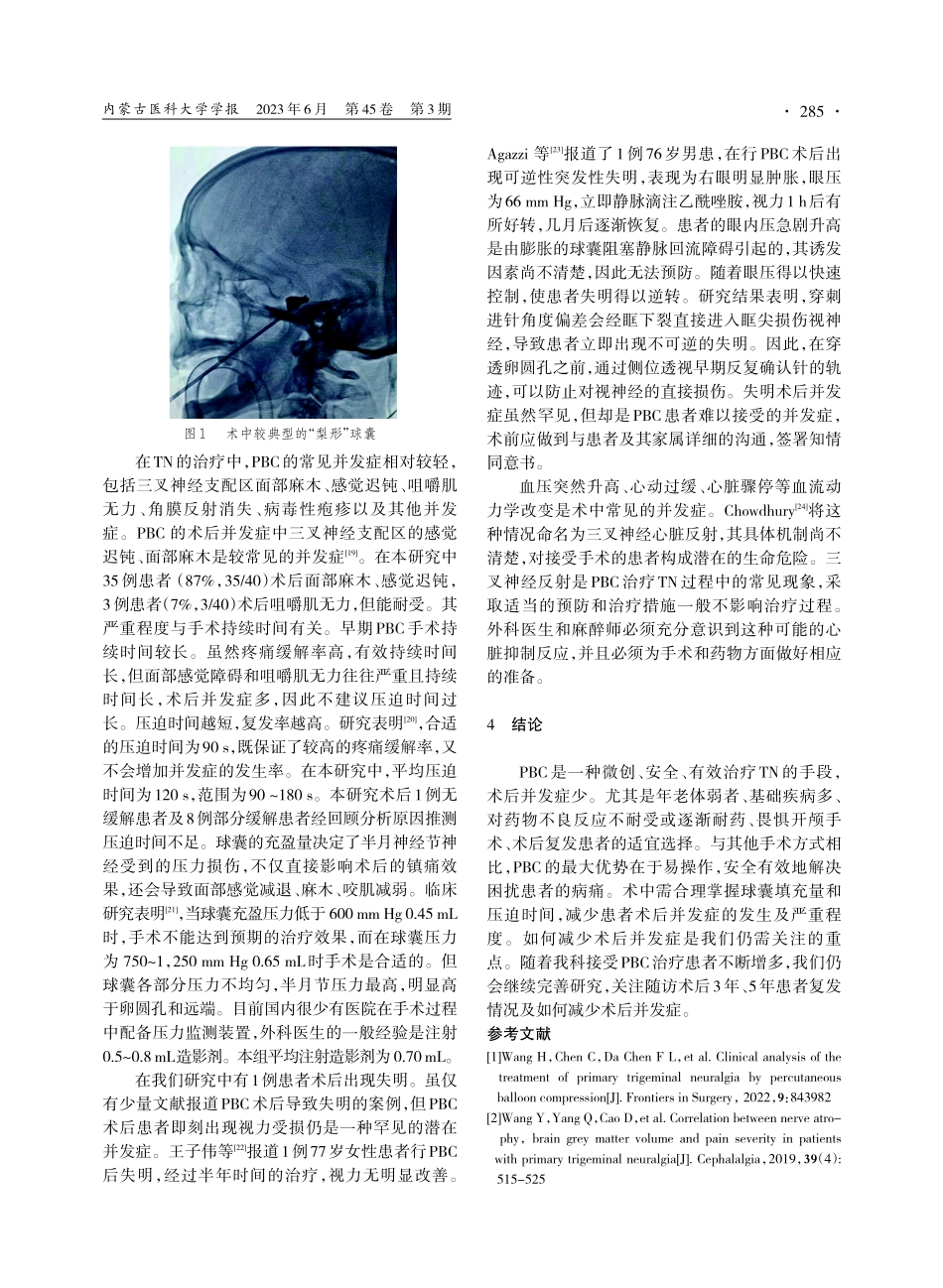 经皮三叉神经半月节球囊压迫术治疗三叉神经痛临床分析.pdf_第3页