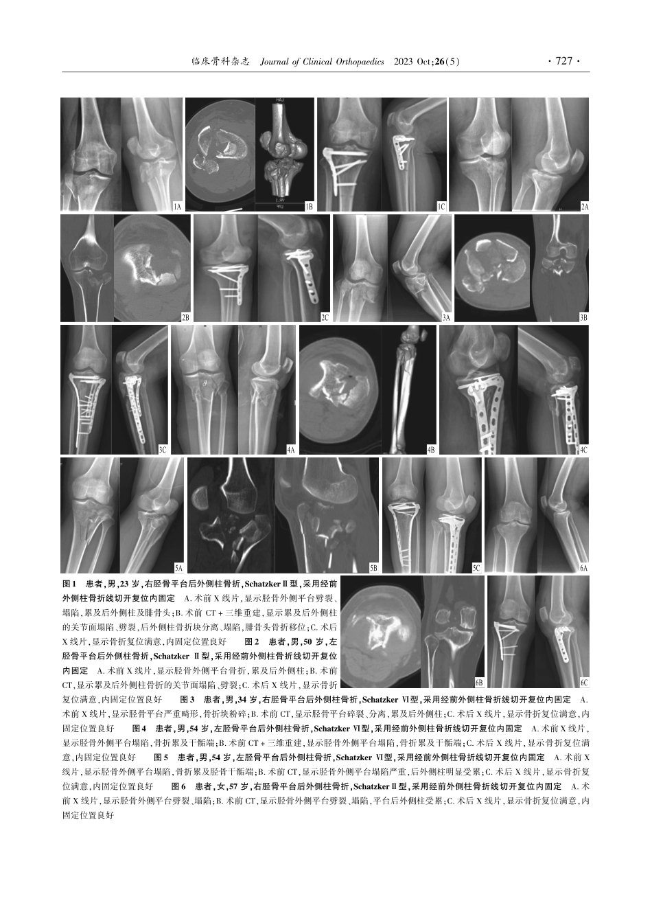 经前外侧柱骨折线切开复位内固定治疗胫骨平台后外侧柱骨折.pdf_第3页