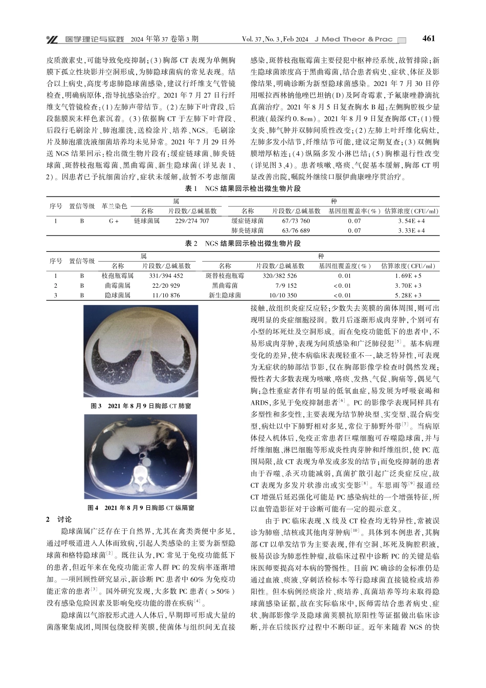 经支气管镜肺泡灌洗明确诊断肺隐球菌病1例并文献复习.pdf_第2页