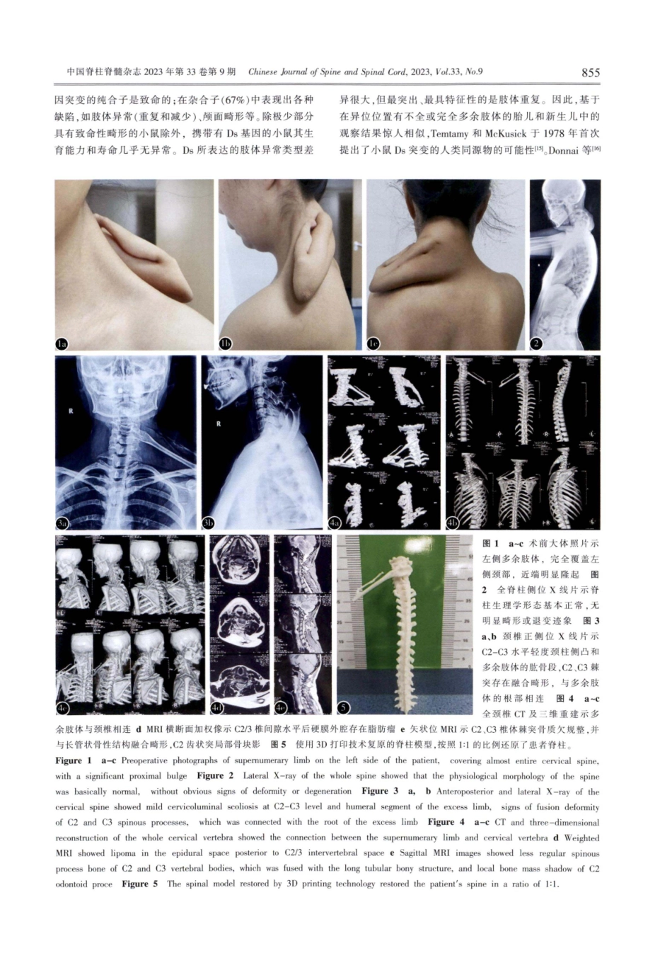 颈椎多肢畸形1例报道并文献复习.pdf_第2页