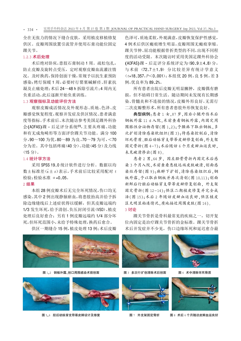 胫后动脉穿支“螺旋桨”皮瓣修复老年踝关节骨折术后踝内侧软组织缺损.pdf_第3页