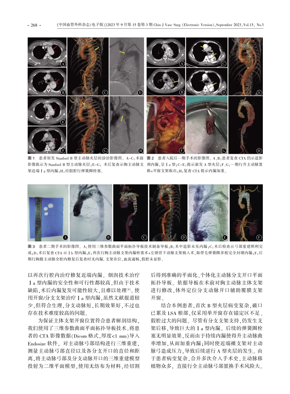 开窗_分支支架技术结合开放手术治疗胸主动脉腔内修复术后难治性内漏1例.pdf_第2页