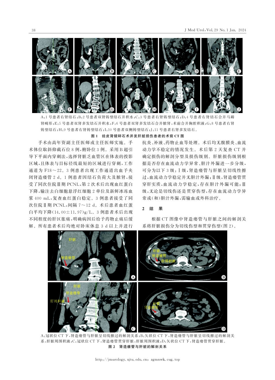 经皮肾镜碎石术并发肝脏损伤11例诊治分析.pdf_第2页