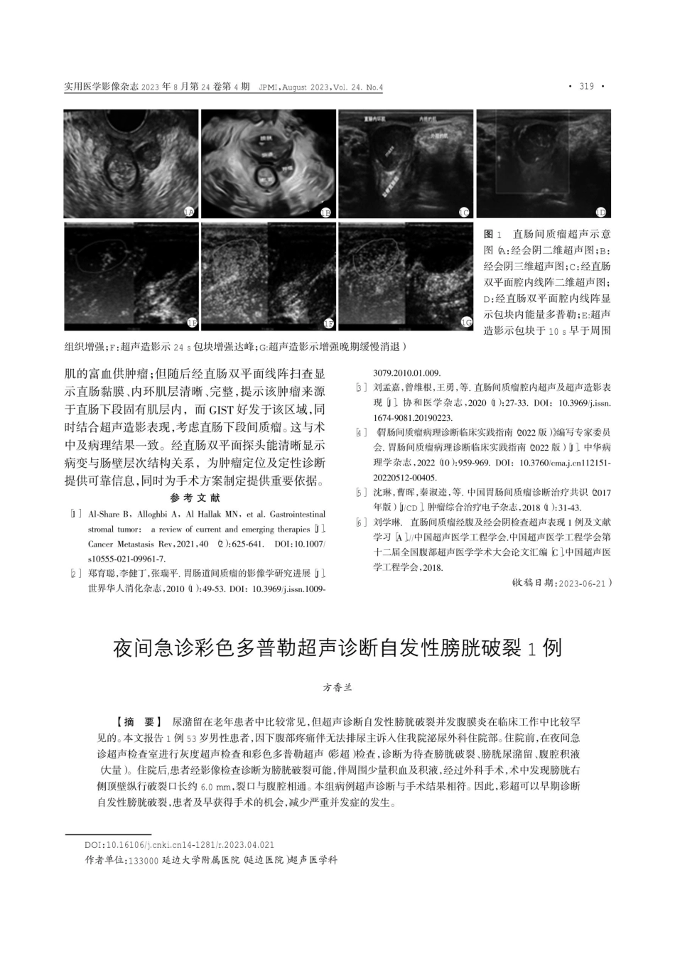 经直肠双平面超声诊断直肠间质瘤1例.pdf_第2页