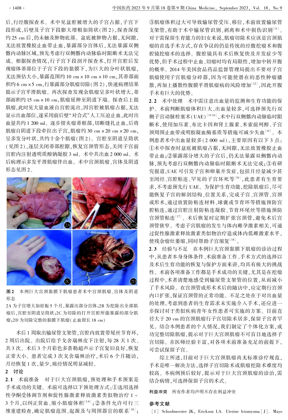 巨大复杂性宫颈黏膜下肌瘤1例.pdf_第2页