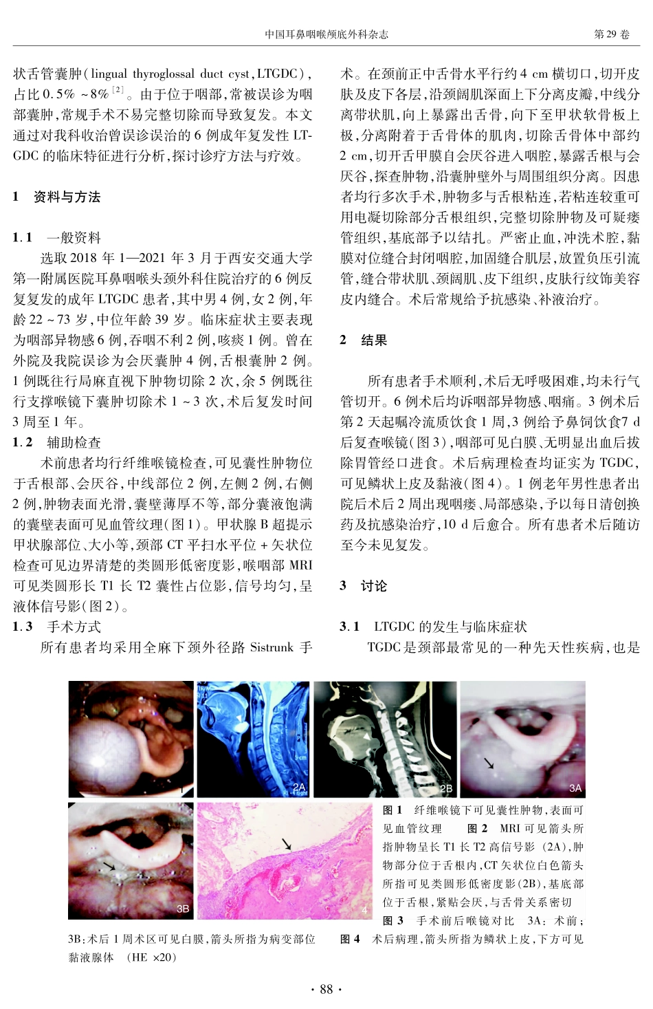 颈外径路Sistrunk手术治疗成人复发性舌甲状舌管囊肿的临床分析.pdf_第2页