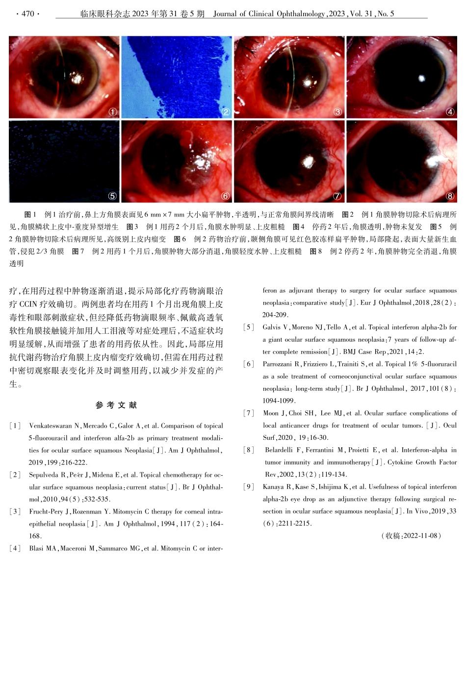 局部化疗药物治疗复发性角结膜上皮内瘤变2例.pdf_第2页