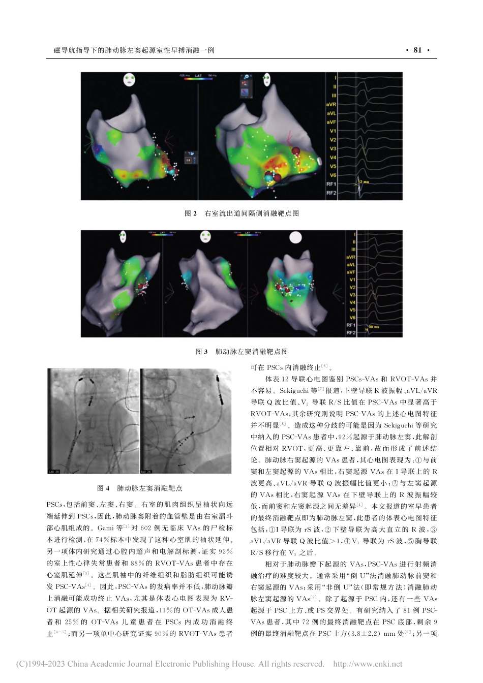 磁导航指导下的肺动脉左窦起源室性早搏消融一例_肖峰.pdf_第2页