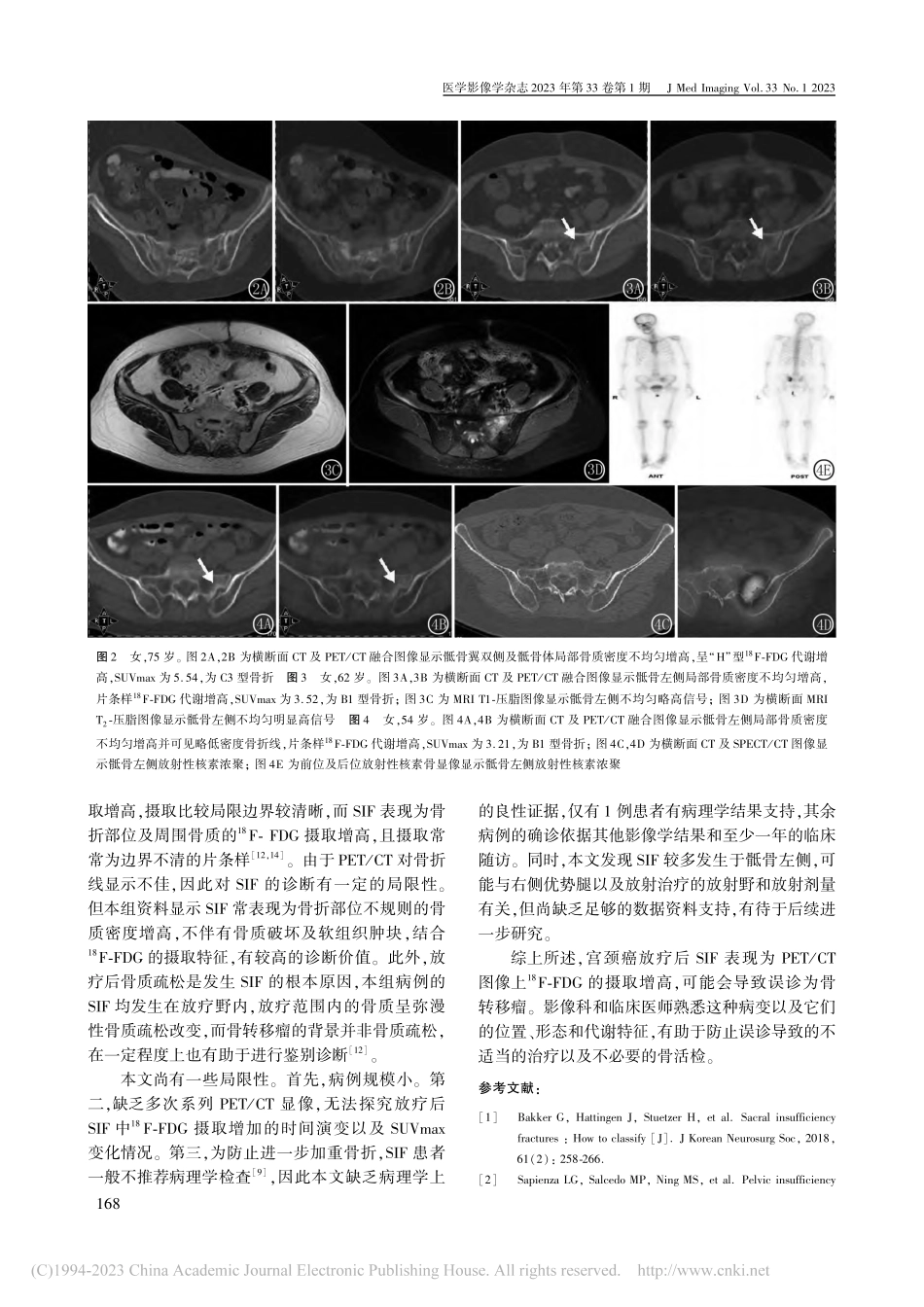 宫颈癌放疗后骶骨衰竭骨折的..._PET_CT图像特征分析_房娜.pdf_第3页